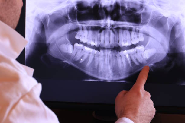 Best Emergency Wisdom Tooth Extraction in Myersville, MD